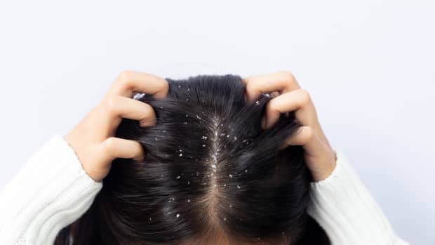 close up of a woman's head and dandruff flakes