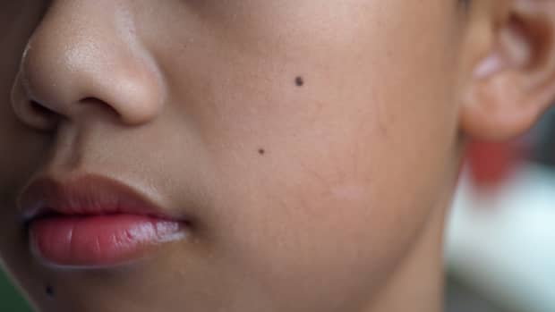 Brown woman with beauty moles on her face