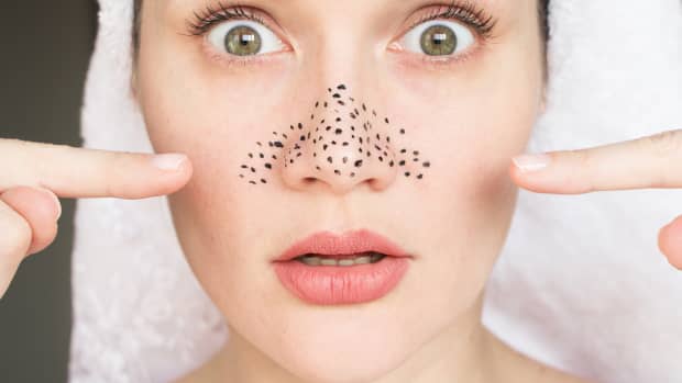 woman points to clogged pores on her nose