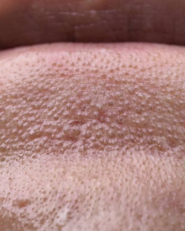 a close-up of chin bumps