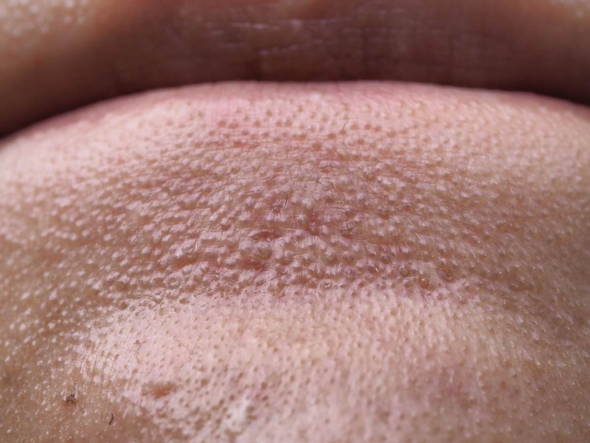 Video Walks You Through How To Remove Small Bumps On Your Chin   Shutterstock 2145639361 